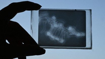 Phagentherapie: Start-up gibt Patient von KI entworfene Viren